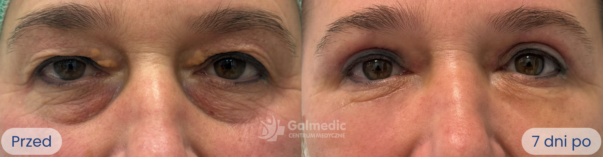 plastyka powiek górnych