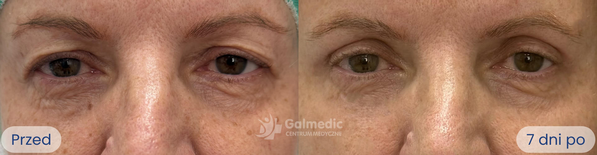 plastyka powiek górnych