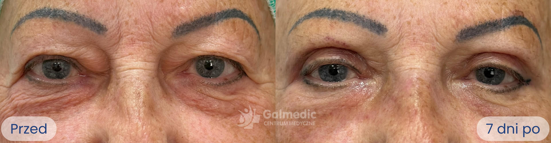 plastyka powiek górnych