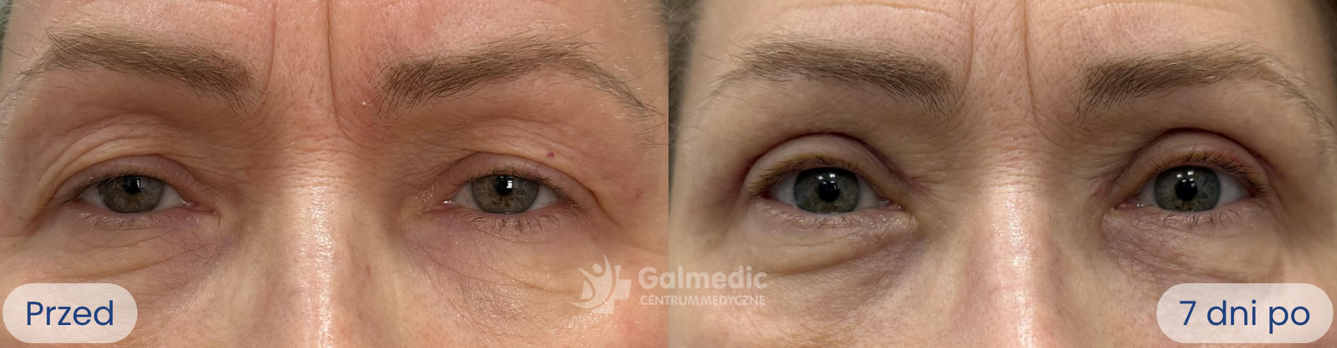 plastyka powiek górnych