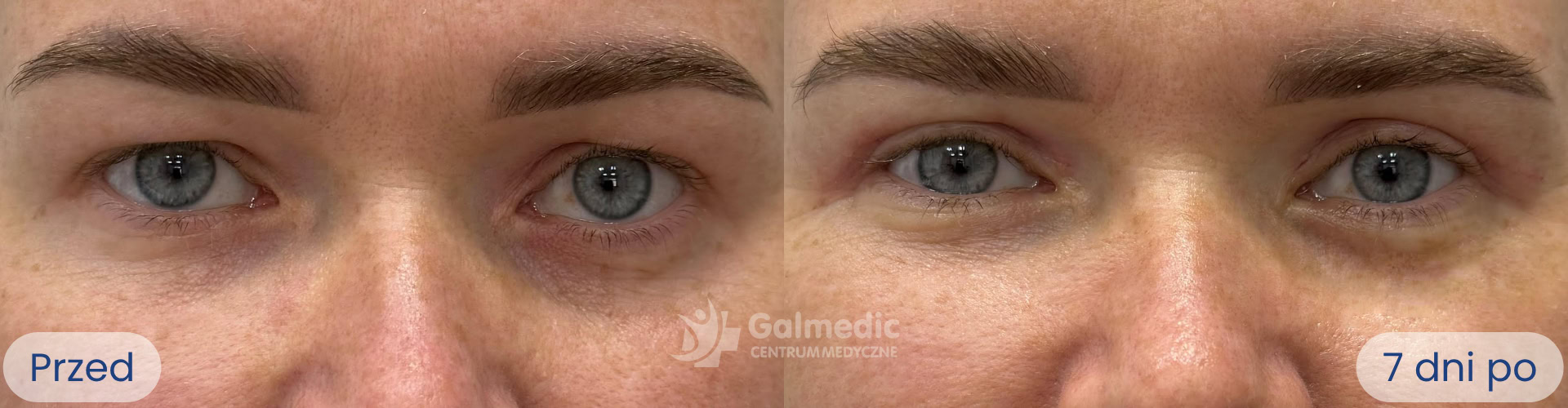 plastyka powiek górnych