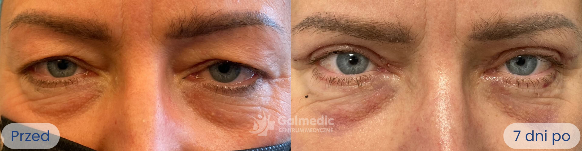 plastyka powiek górnych