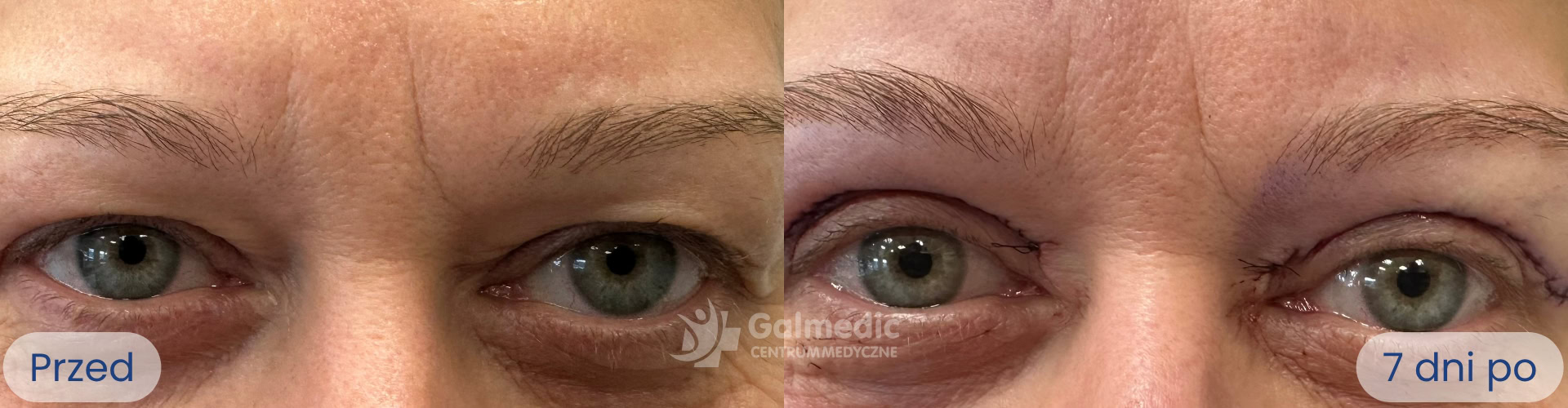 plastyka powiek górnych