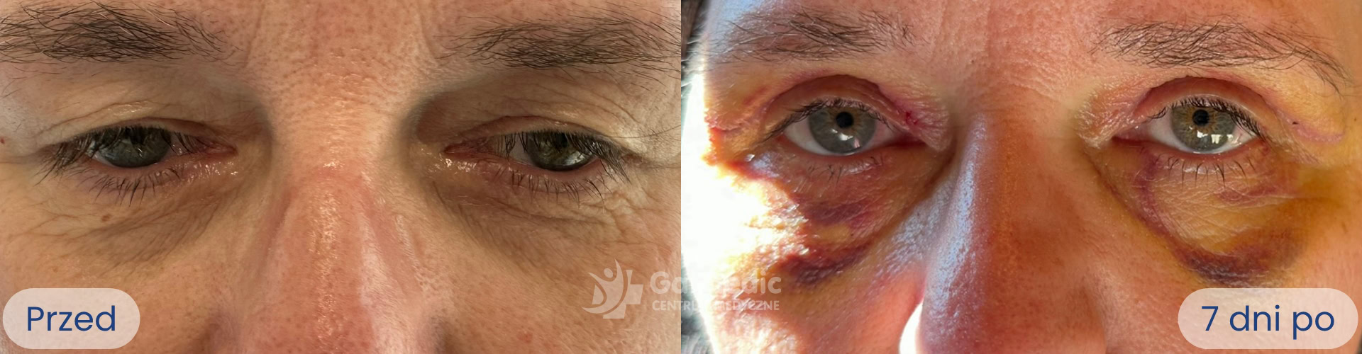 plastyka powiek górnych