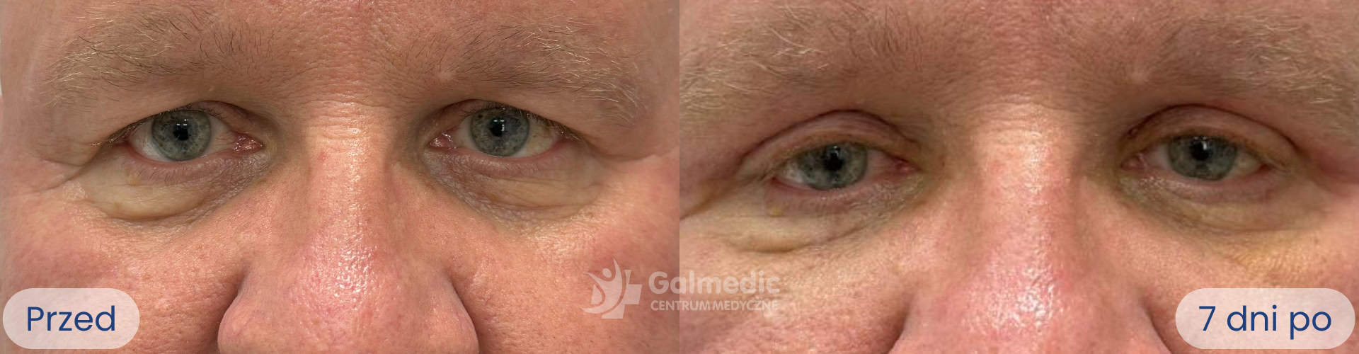 plastyka powiek górnych