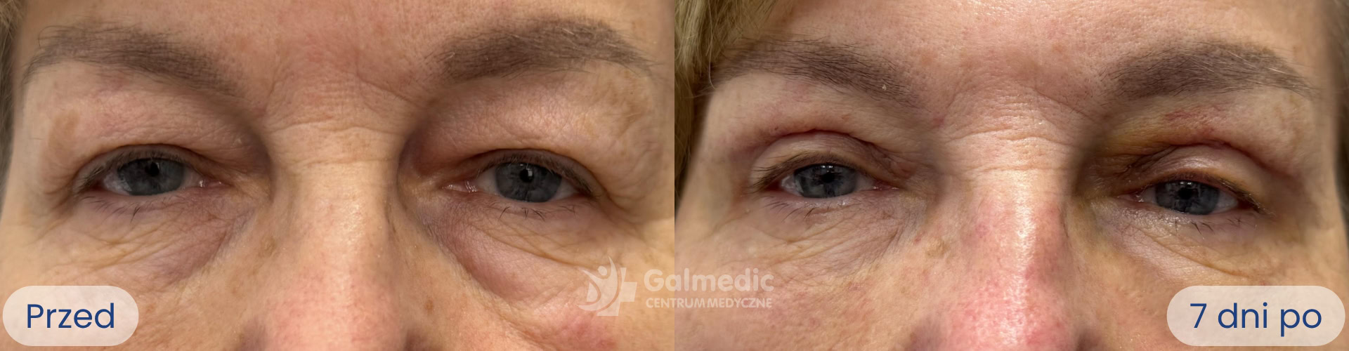 plastyka powiek górnych