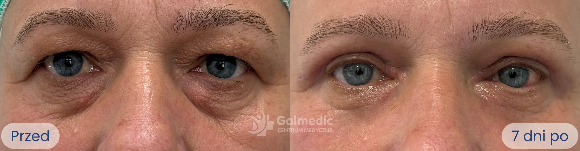 plastyka powiek górnych