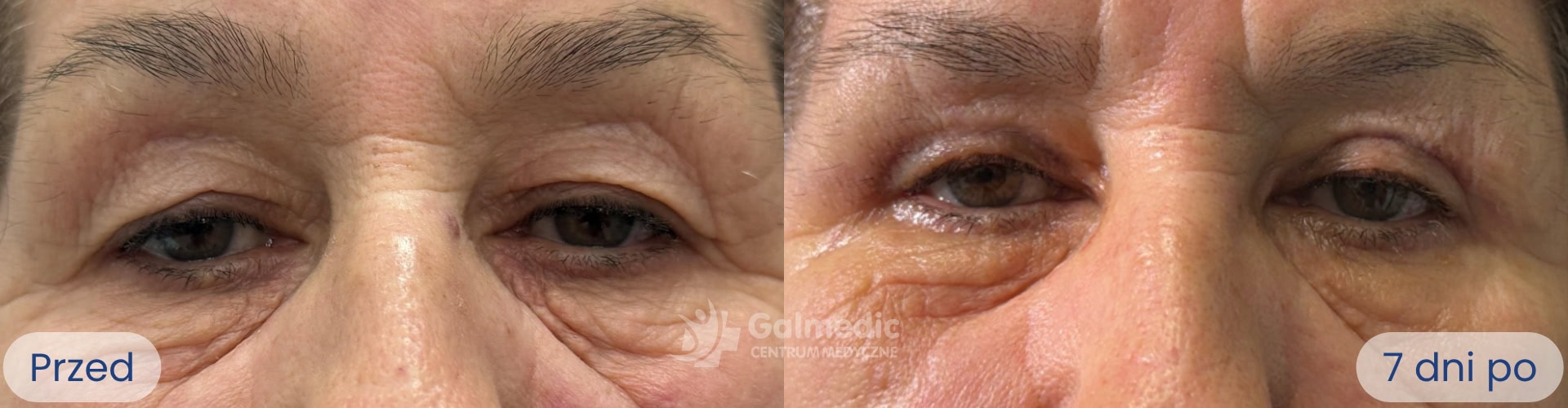 plastyka powiek górnych