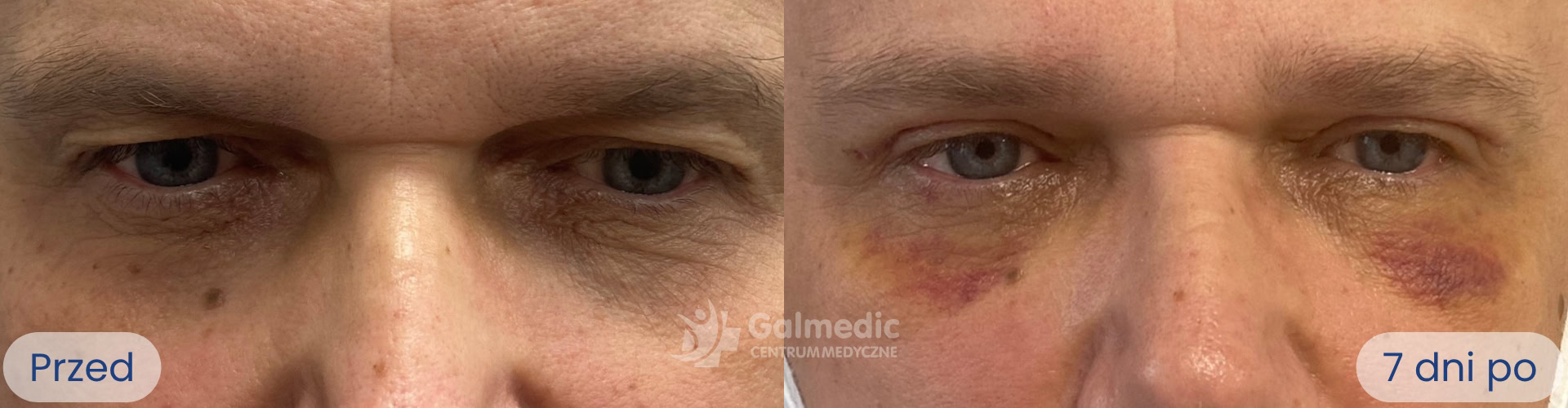 plastyka powiek górnych