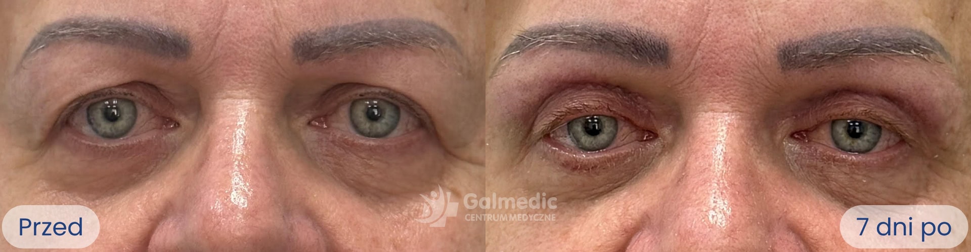 plastyka powiek górnych