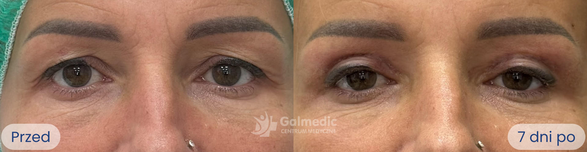 plastyka powiek górnych